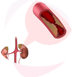 Renal Angioplasty Restoring Kidney Blood Flow