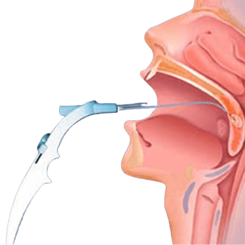 Somnoplastika – Xurrakni davolash jarrohligi