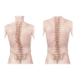 Spinal Deformity Correction Surgery