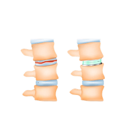 Spinal Disc Replacement