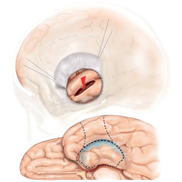 Temporal Lobectomy