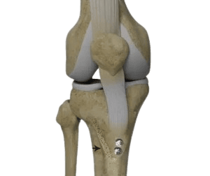 Tirsak suyagi tuberkulasini ko'chirish patellofemoral artrit
