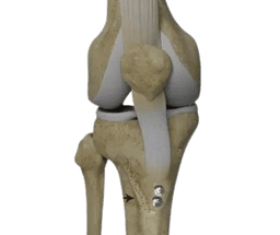 Tibial Tubercle Transfer Patellofemoral Arthritis