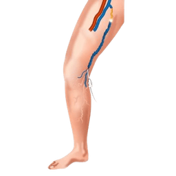 Varicose Veins Ablation