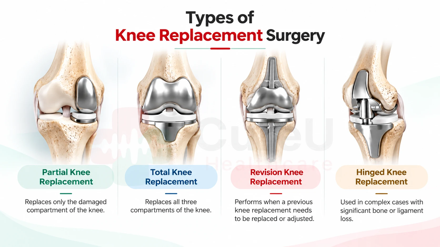 types of knee replacement surgery