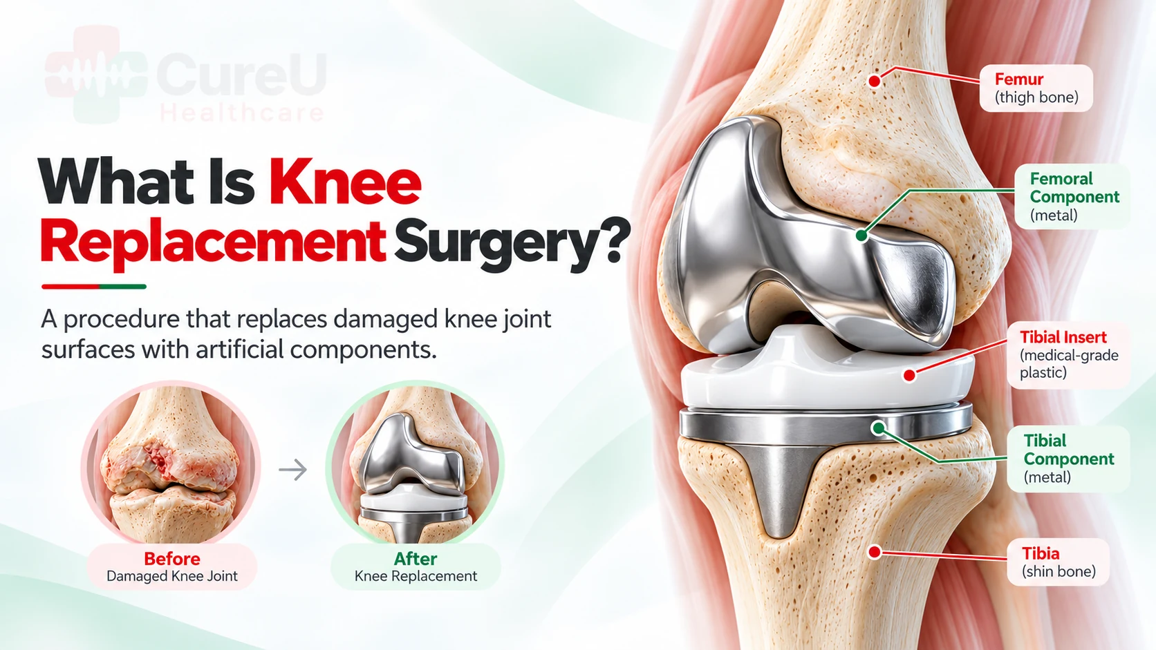 what is knee replacement surgery